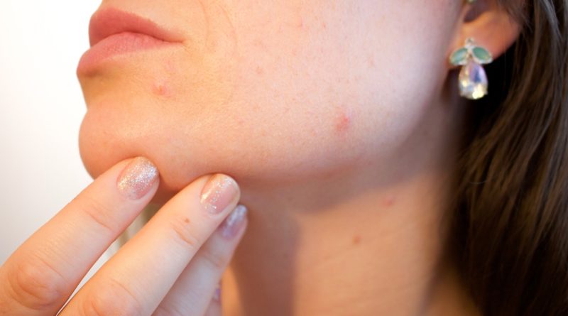 Mejora tu acné de manera natural